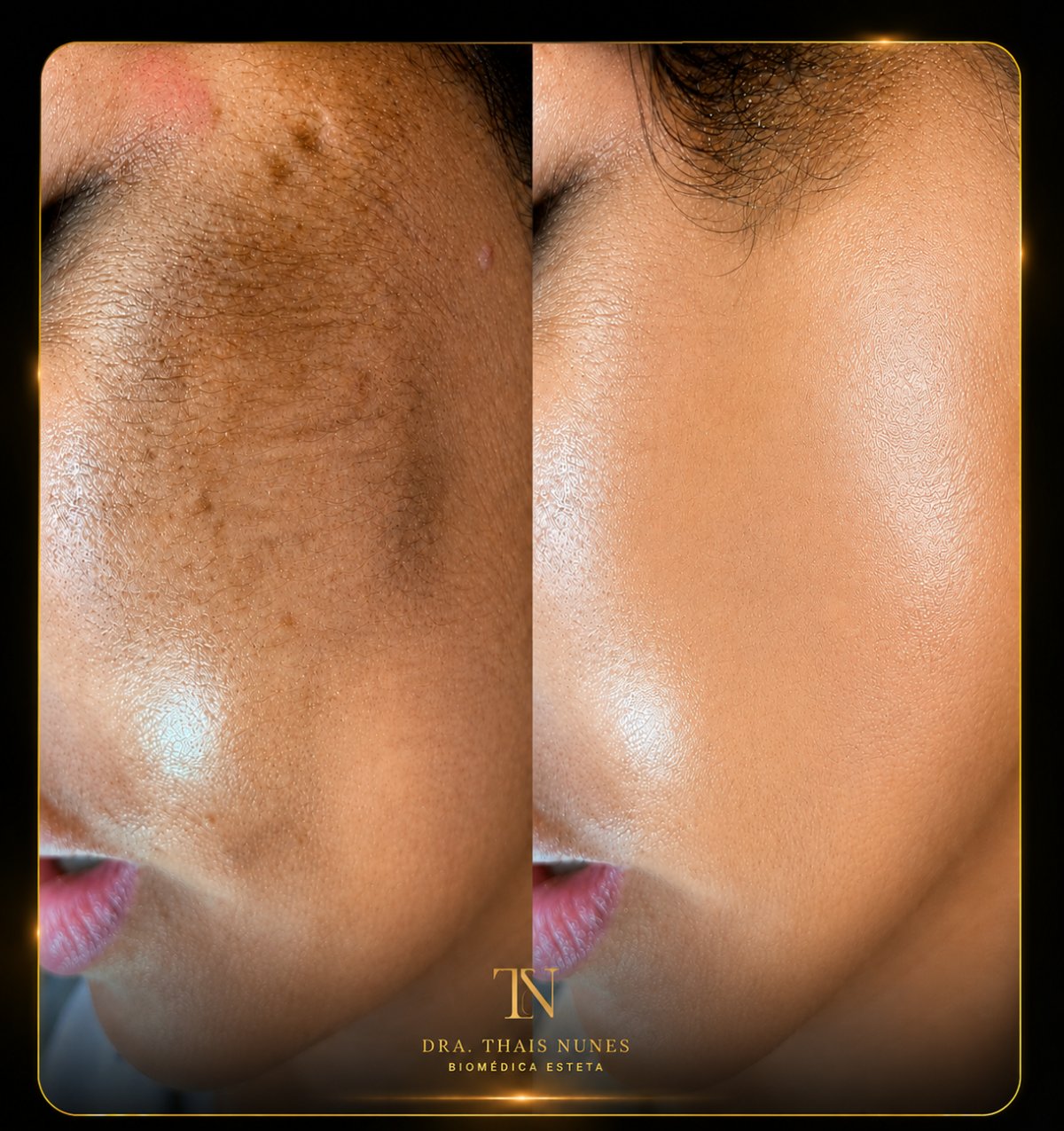 Resultado Dermaplaning