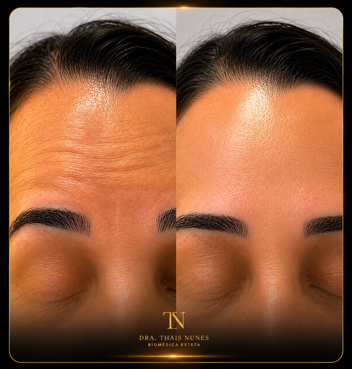 Resultado Botox