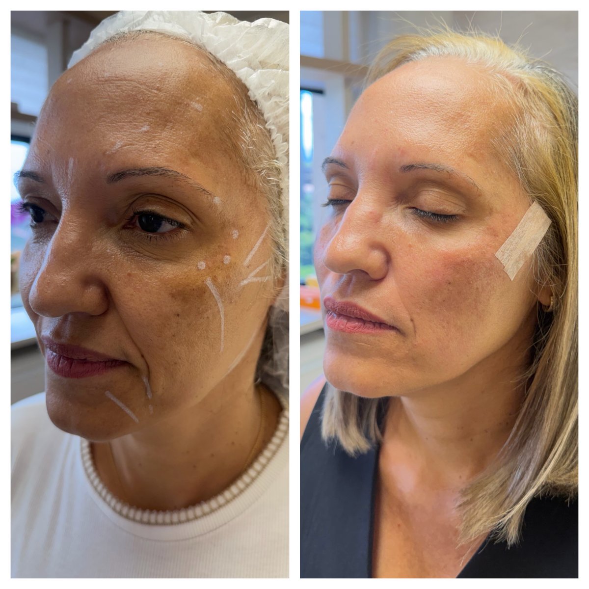 L-Lift Exclusive na Lenzavi Clinic