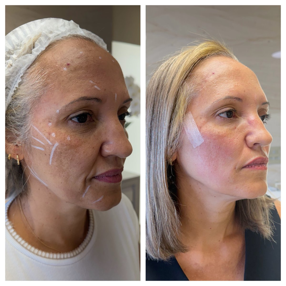 L-Lift Exclusive na Lenzavi Clinic